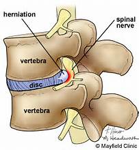 Hoe behandel je een hernia of een discus hernia?